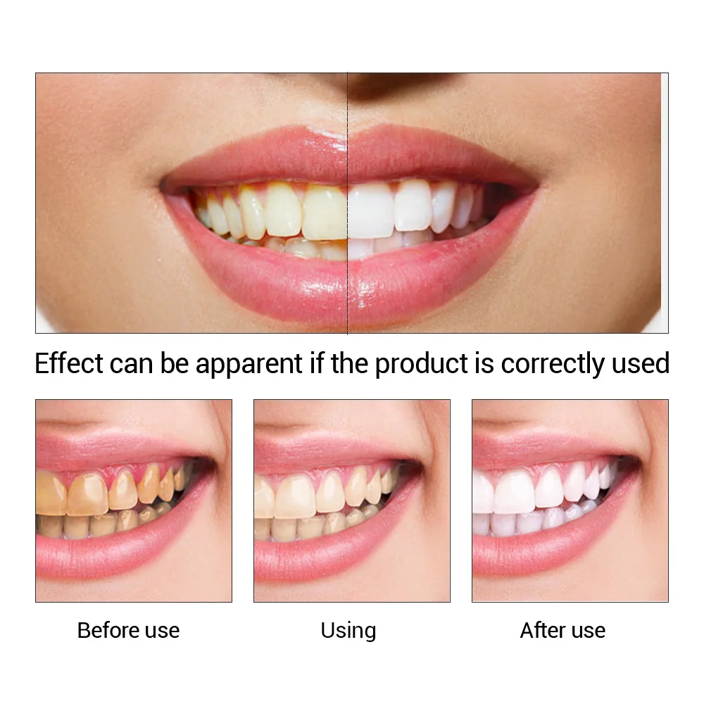 FTEENPLY Teeth Whitening Essen - Teeth Whitening/Bleaching incelemesi ve fiyatı