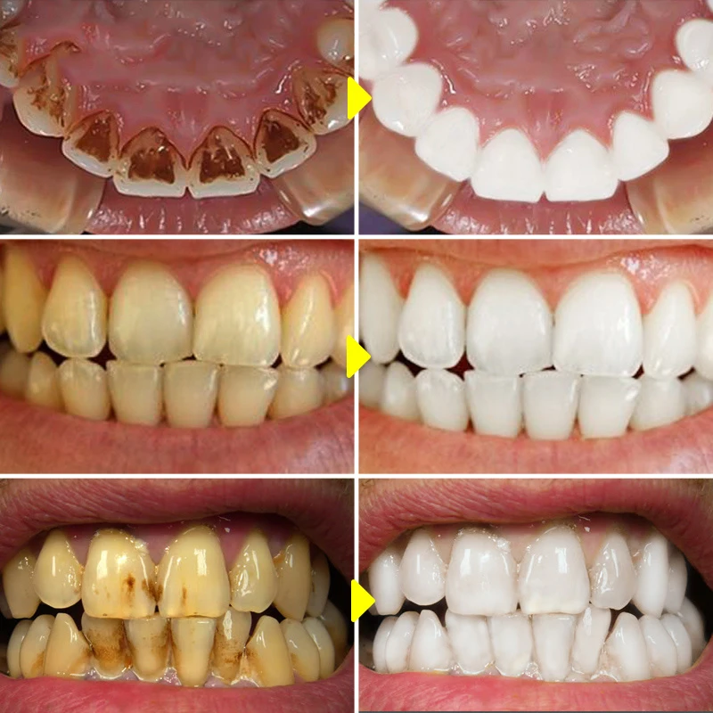 V34 Teeth Whitening Mousse Too - Teeth Whitening/Bleaching incelemesi ve fiyatı